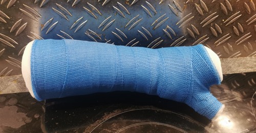 Gipsarm unterarmgips mit - unterarmgips,